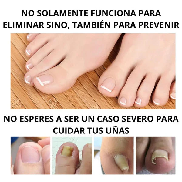 CLEARNAIL PRO ™ - Tratamiento para eliminar Hongos de uñas (Compre 1 y Reciba 2)